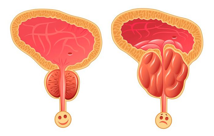 Normal an entzündegt Prostata