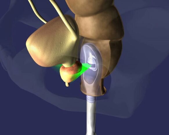 Ultraschallbehandlung vun der Prostata fir Prostatitis
