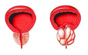 Prostata am normalen Zoustand (lénks) an entzündegt mat Prostatitis (riets)
