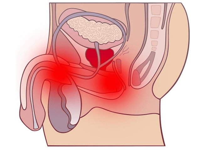 Entzündung vum Genitaltrakt mat Prostatitis